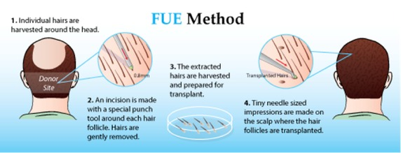 FUE Hair Transplant in Gurgaon