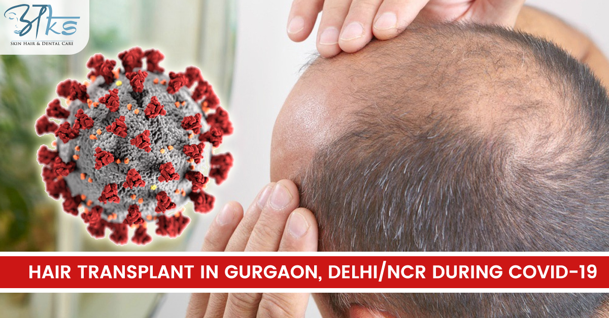 Hair Transplant in Gurgaon, Delhi/NCR during Covid-19