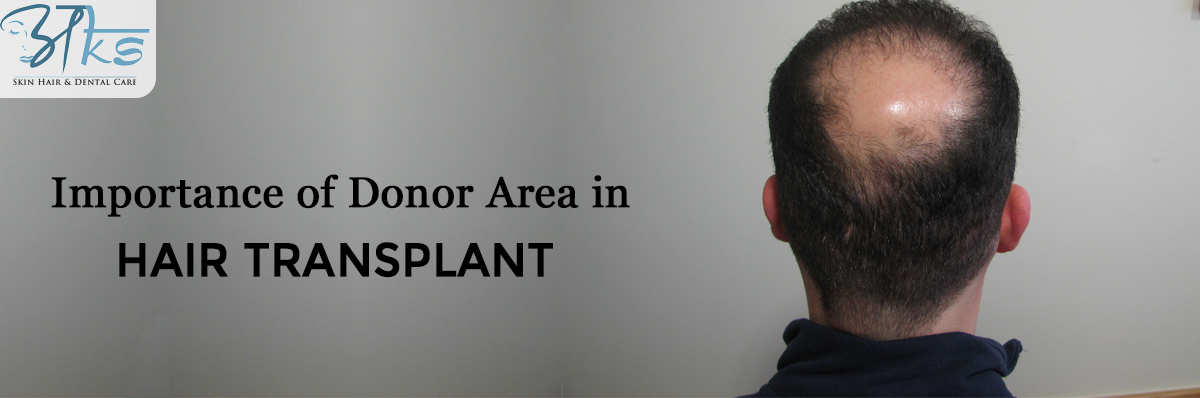 Importance of Donor Area in Hair Transplant