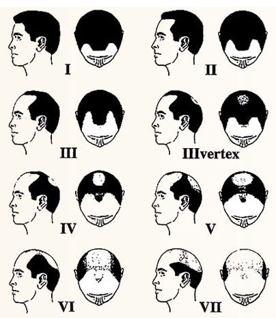 Norwood HairLine Classification For Men
