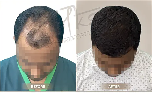 AKS clinic Before and After 17 AKS clinic Before and After 17