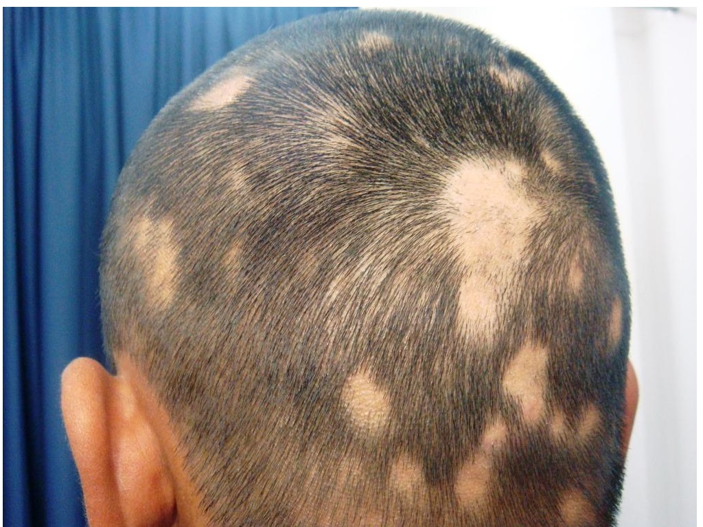 hair loss clinic in gurgaon