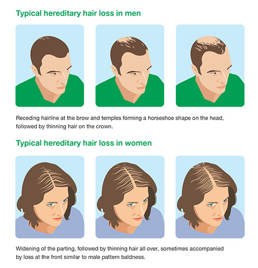 Know More About Pattern Hair Loss In Men - AKS Clinic