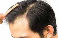 After Hair Transplant Care best hair transplant clinic in delhi