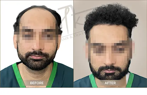 AKS clinic Before and After 17