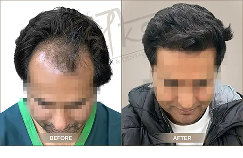 AKS clinic Before and After 17