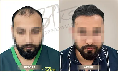 AKS clinic Before and After 17 AKS clinic Before and After 17