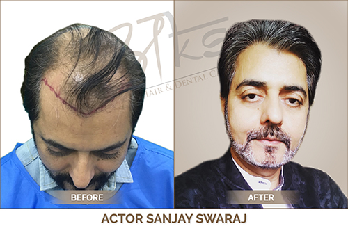 Hair Transplant Result Delhi