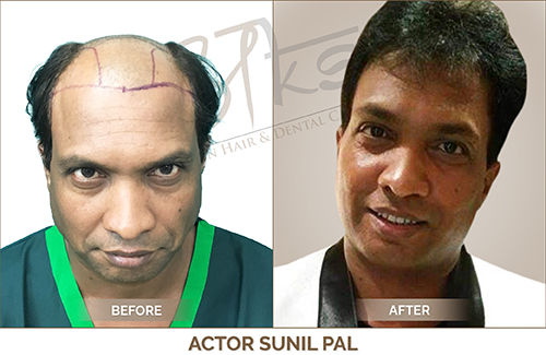 Before and After Results by AKS Clinic Gurgaon & Delhi