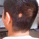 Alopecia Areata Can Be Treated