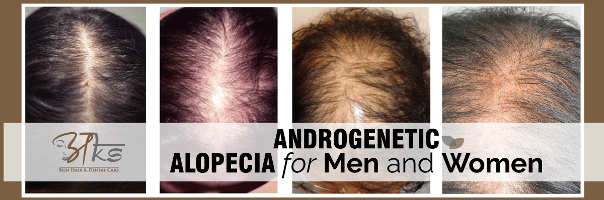 Androgenetic Alopecia For Men and Women