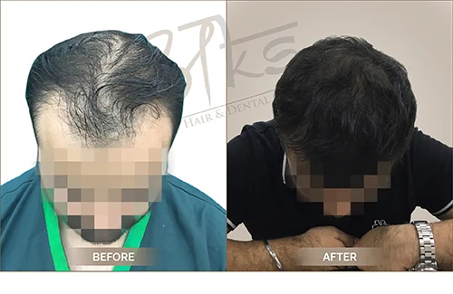 Hair Transplant Clinic in Gurgaon - Best Hair Doctor at Affordable Cost