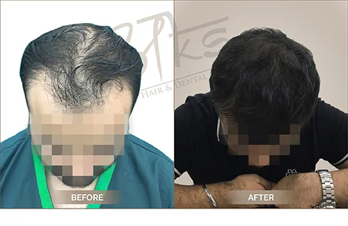 AKS clinic Before and After 10 AKS clinic Before and After 10