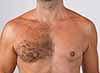 Body Hair Transplant beard transplant clinic in delhi