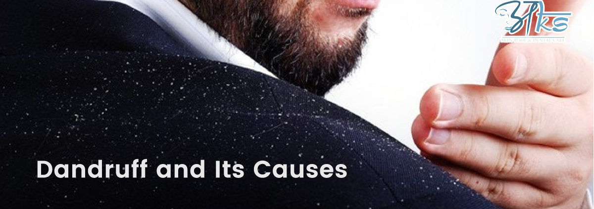 Causes of Dandruff