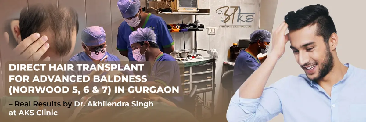 Direct Hair Transplant for Norwood 5–7