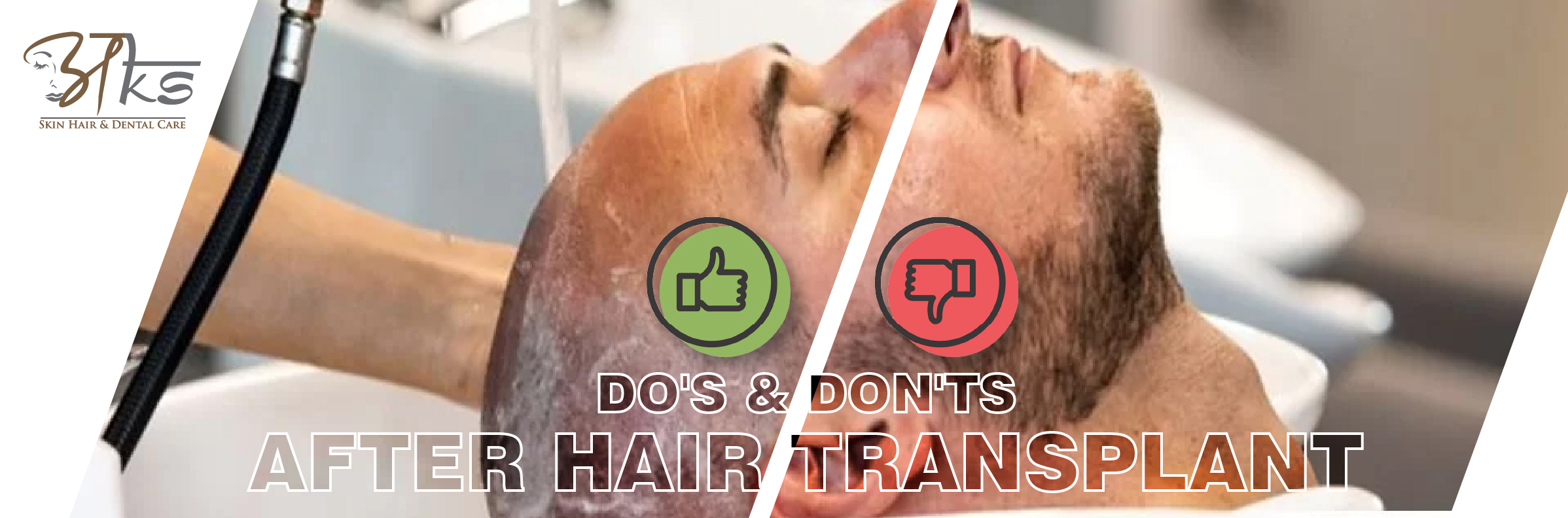 Hair transplant in Delhi