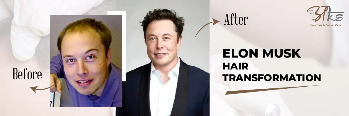 Elon Musk Hair Transformation