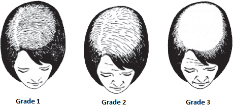 Ludwig Hairline Classification For Women