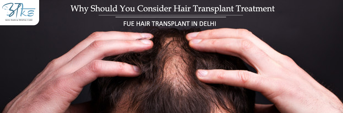 Fue Hair Transplant In Delhi