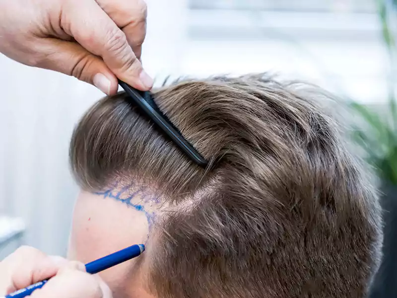 FUE Hair Transplant