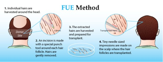 Scalp Micropigmentation Treatment