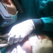 Hair Transplant Surgery