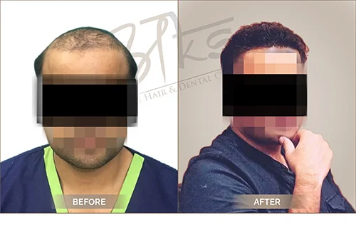 AKS clinic Before and After 7 AKS clinic Before and After 7