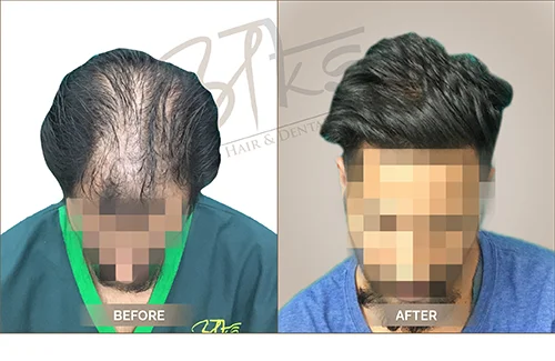 AKS clinic Before and After 8 AKS clinic Before and After 8