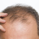 What is Hair Loss?