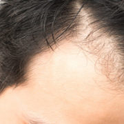 Hair Transplant Treatment Clinic in Gurgaon