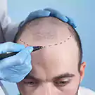 Hair Transplantation