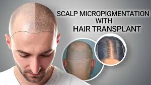 Scalp Micropigmentation Treatment
