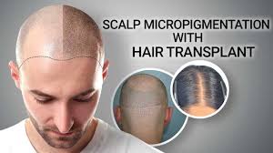 Scalp Micropigmentation Procedure Scalp Micropigmentation Treatment