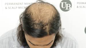 Scalp Micropigmentation Treatment