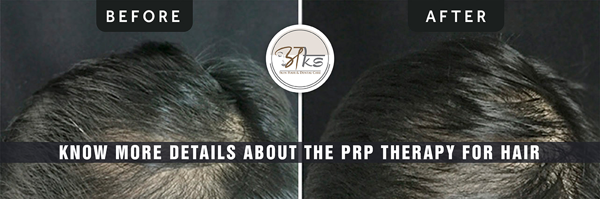 Know more details about the PRP therapy for hair 