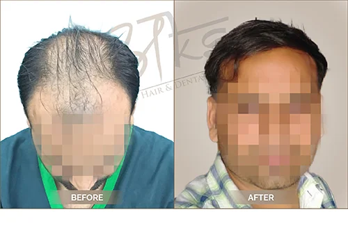 AKS clinic Before and After 14 AKS clinic Before and After 14