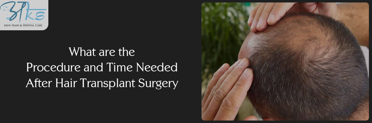 Time Needed After Hair Transplant Surgery