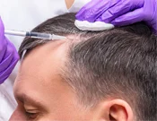 Hair Transplant Doctor PRP Hair Transplant