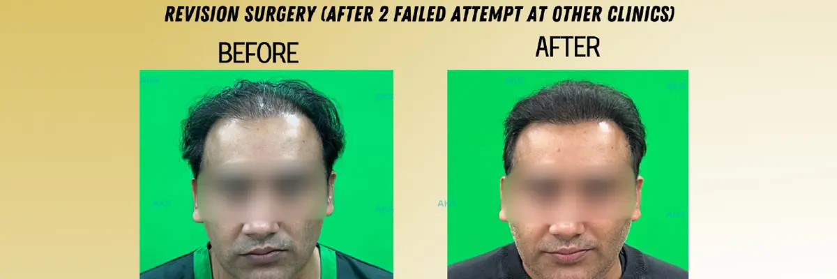 Revision hair transplant before and after result