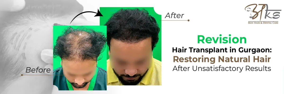 Revision Hair Transplant in Gurgaon