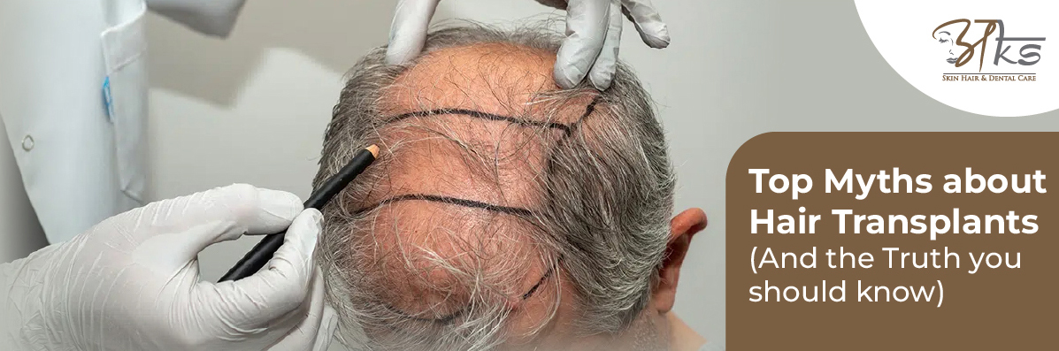 Top Myths About Hair Transplants