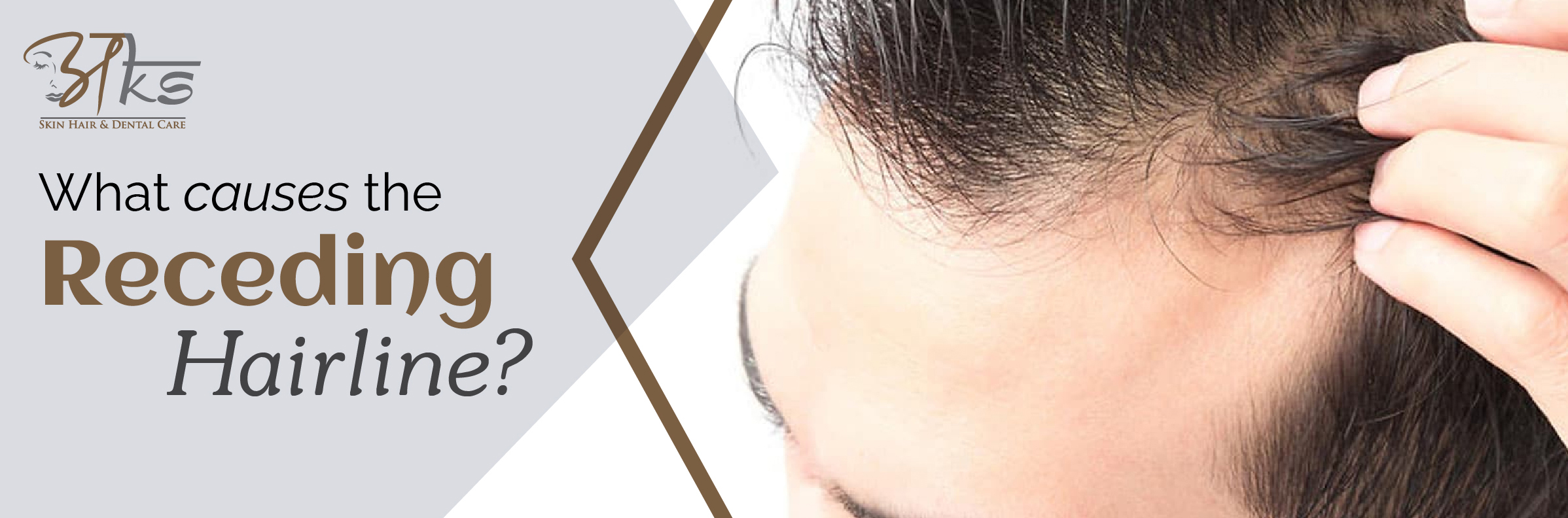 Hair transplant in Delhi