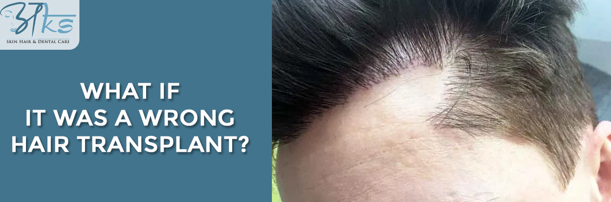 What If It Was a Wrong Hair Transplant?