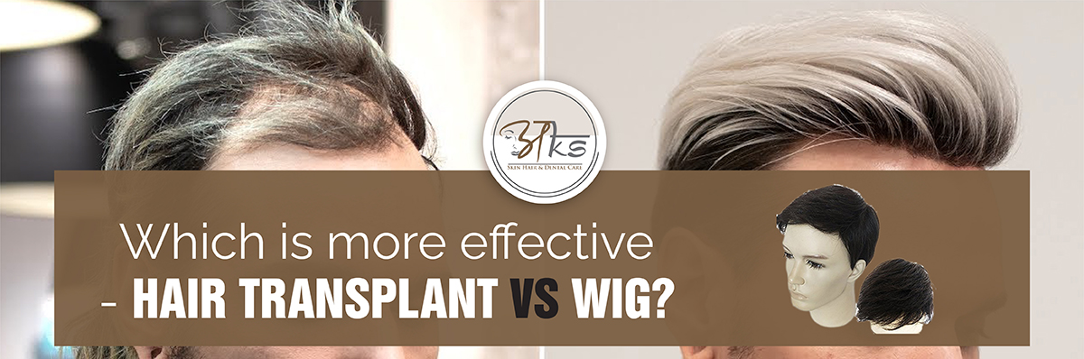 Which is more effective - Hair Transplant VS Wig 