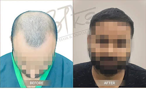 AKS clinic Before and After 4 AKS clinic Before and After 4