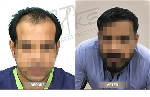 AKS clinic Before and After 13 AKS clinic Before and After 13