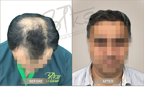AKS clinic Before and After 6 AKS clinic Before and After 6