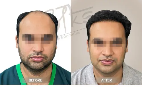 AKS Clinic Before and After AKS Clinic Before and After