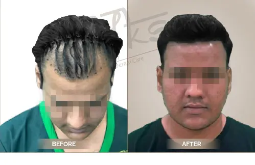 AKS Clinic Before and After AKS Clinic Before and After